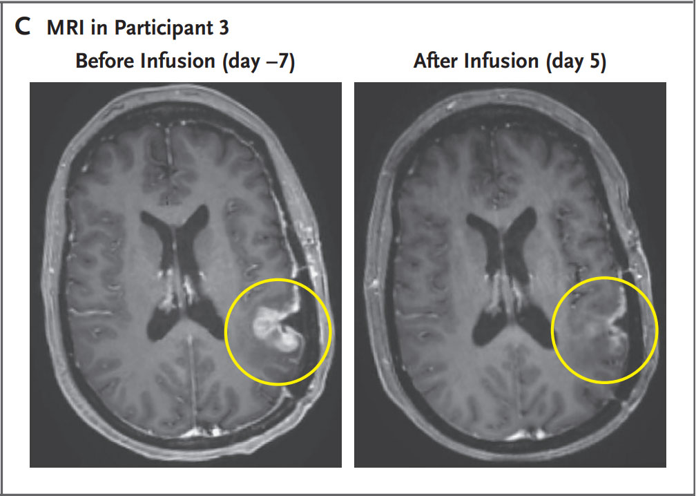 MRI results in Participant 3, before infusion (day -7) and after infusion (day 5)