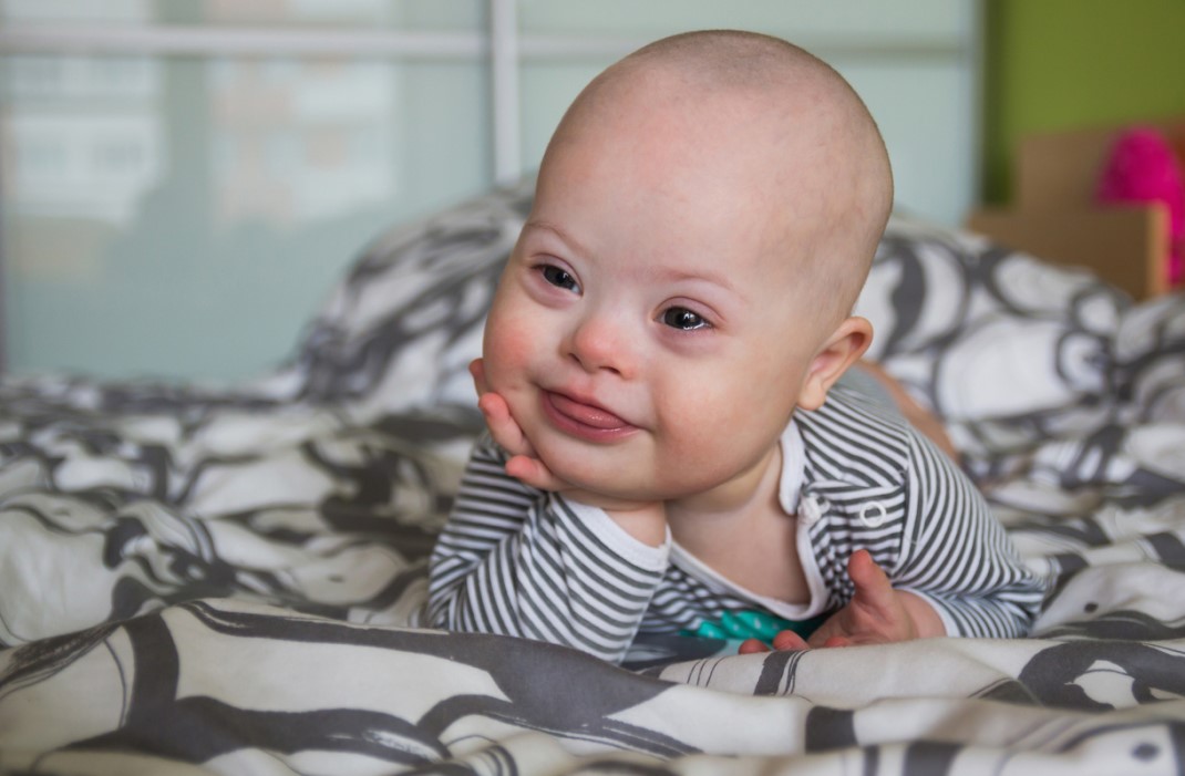 Caring for a Child With Down Syndrome