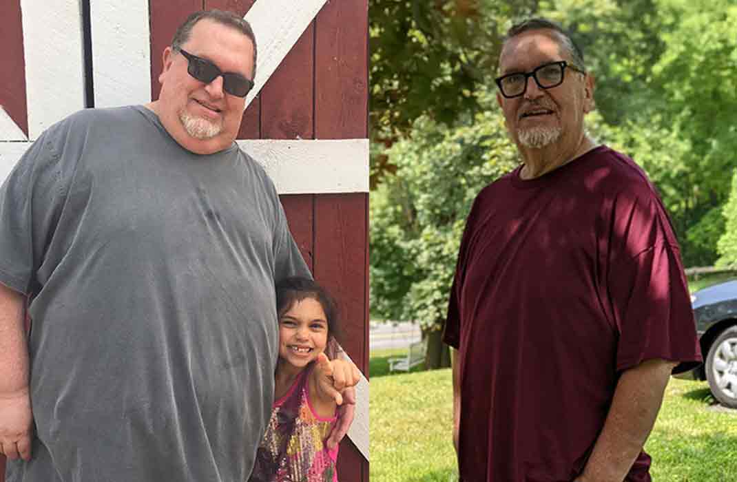 Weight loss surgery patient Charles Peterson before and after his sleeve gastrectomy bariatric surgery.