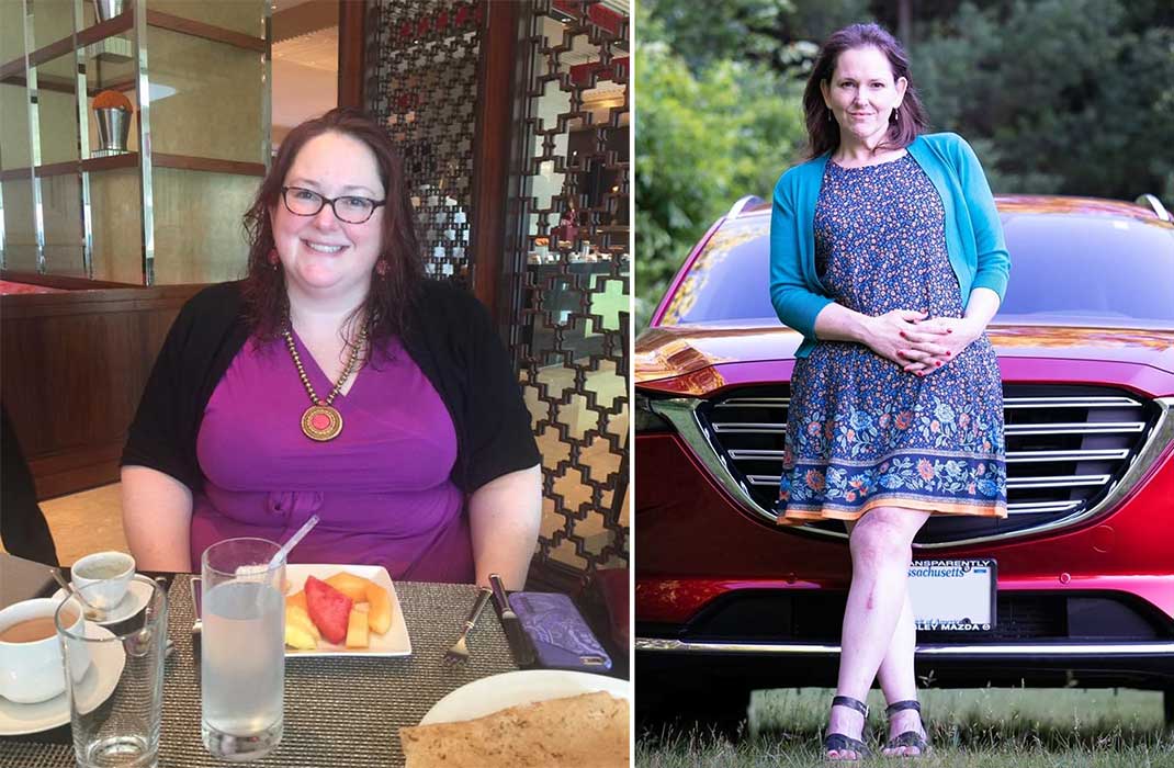 Newton-Wellesley Hospital weight loss surgery patient Julie Bice, before and after surgery