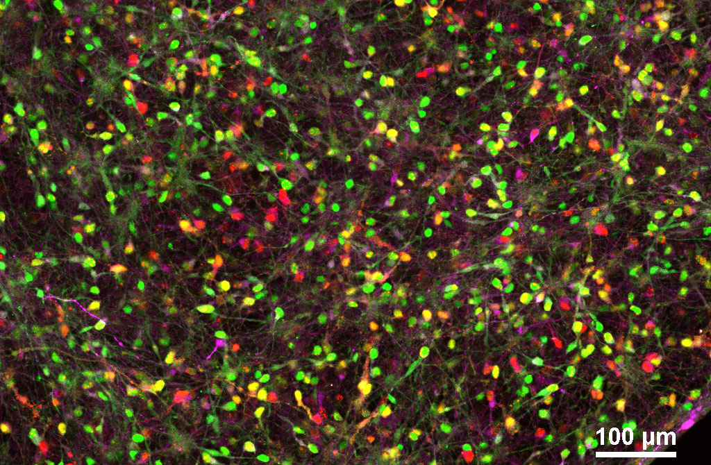 Study Illuminates How an Antiviral Defense Mechanism May Lead to Alzheimer’s Disease