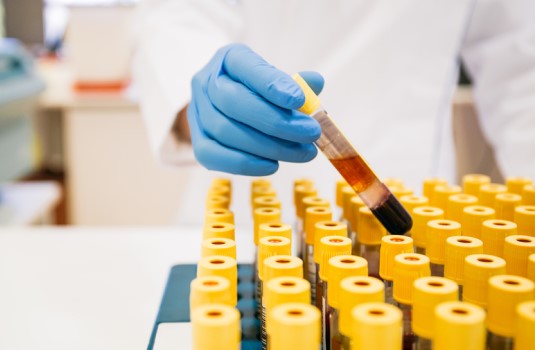 Vials of blood for testing