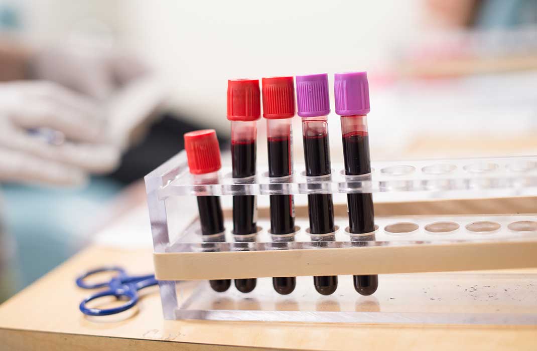 Ultrasensitive Blood Test Detects ‘Pan-Cancer’ Biomarker