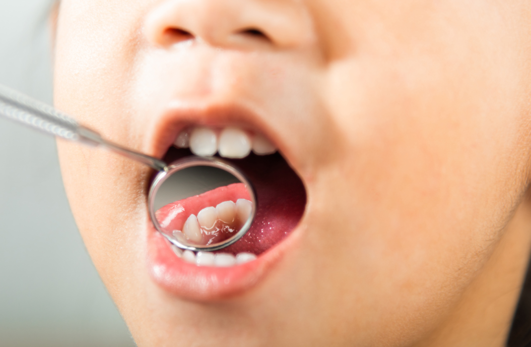 Modeling Study Predicts National Fluoride Ban Would Substantially Increase Children’s Tooth Decay and Dental Costs
