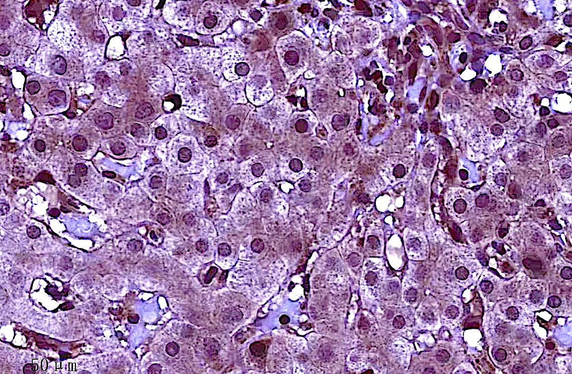 Study Identifies Ways to Lower Risk of Liver Cancer for People with Hepatitis B Infection