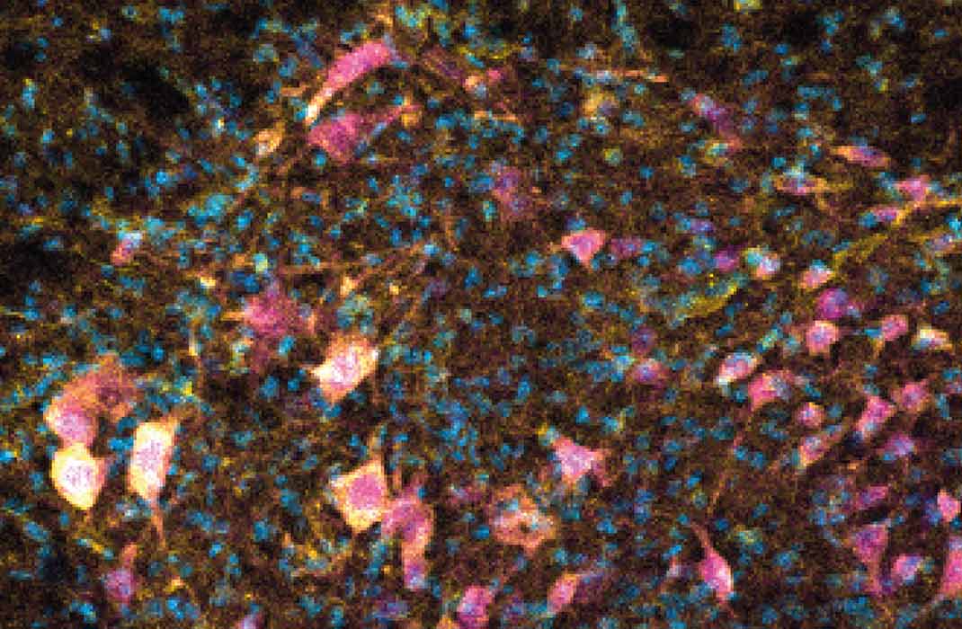 Exercise Hormone Irisin Could Offer Neuroprotective Effects in Multiple Sclerosis