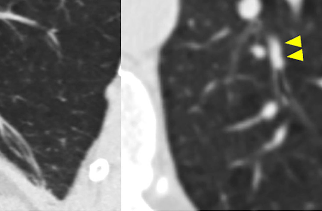 Persistent Mucus Plugs Linked to Faster Decline in Lung Function for Patients with COPD