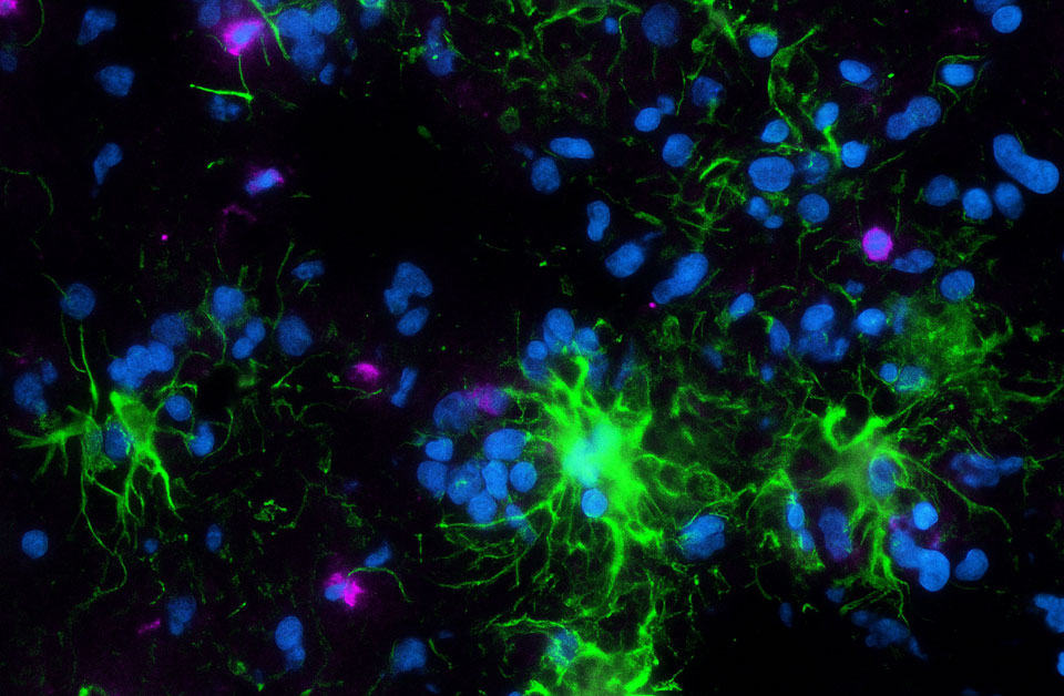 Repeated Brain Tumor Sampling Uncovers Treatment Response in Patients with Glioblastoma