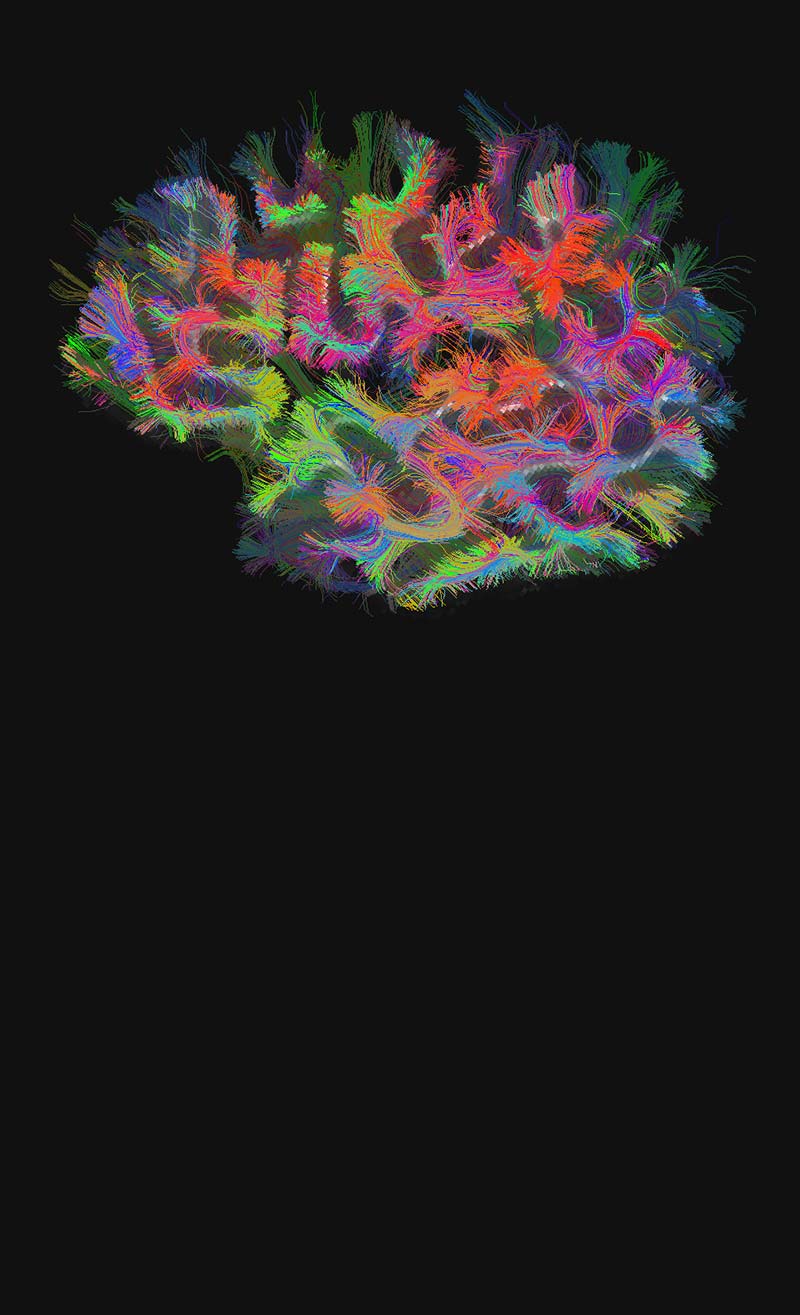 A map of brain connections computed from a diffusion MRI (dMRI) scan..