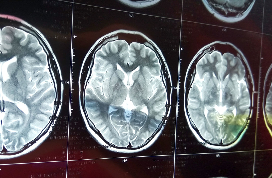 Brain scan