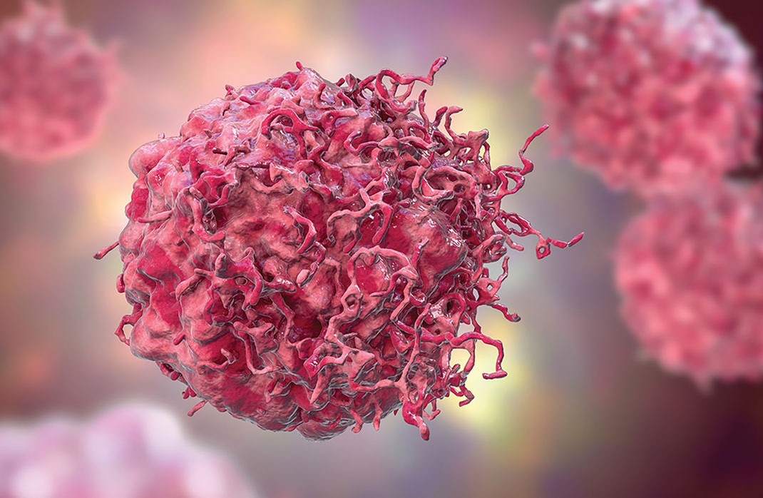 The Clinical Evolution of CAR T-cell Therapy
