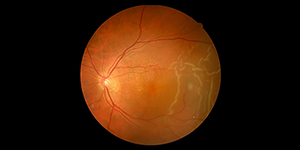 image of the retina