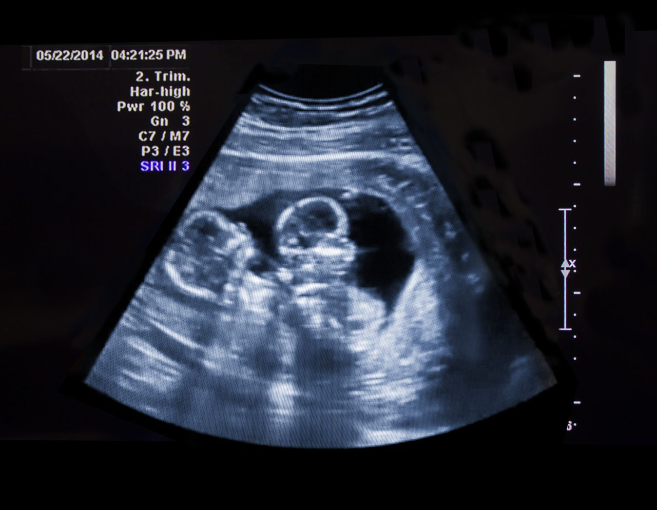ultrasound of a baby