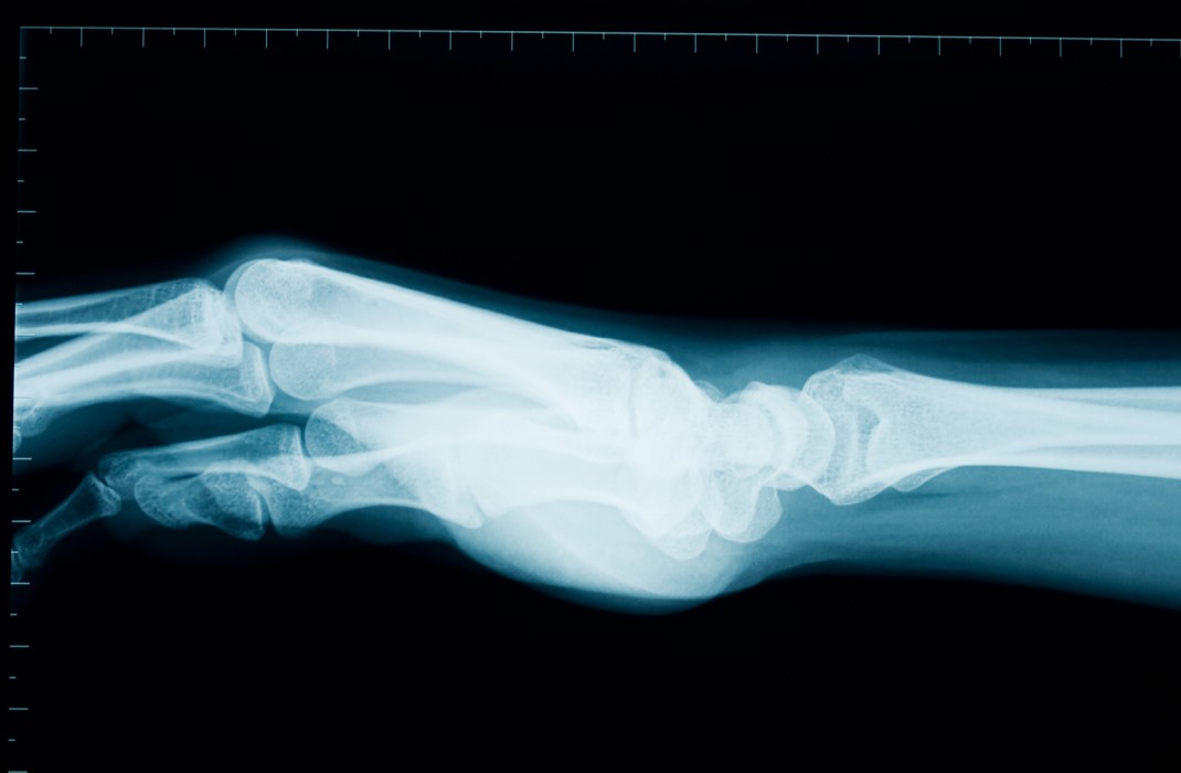 X-ray of a hand