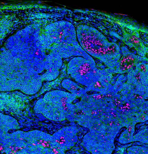Tumor cells from basal cell carcinoma patient. Tumor cells express Foxc1 protein (red), which suppresses HLA class I (green) in the tumor cells.