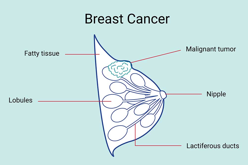 Cross-section of a breast with the parts labeled, including a malignant tumor.