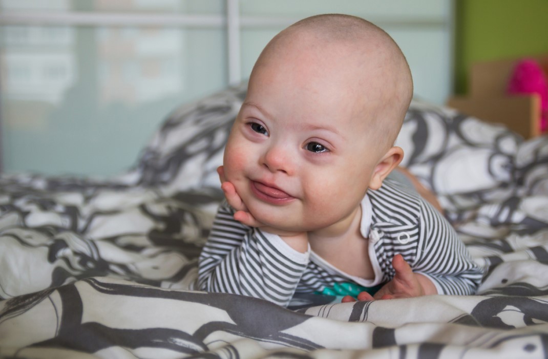 A baby boy with Down syndrome