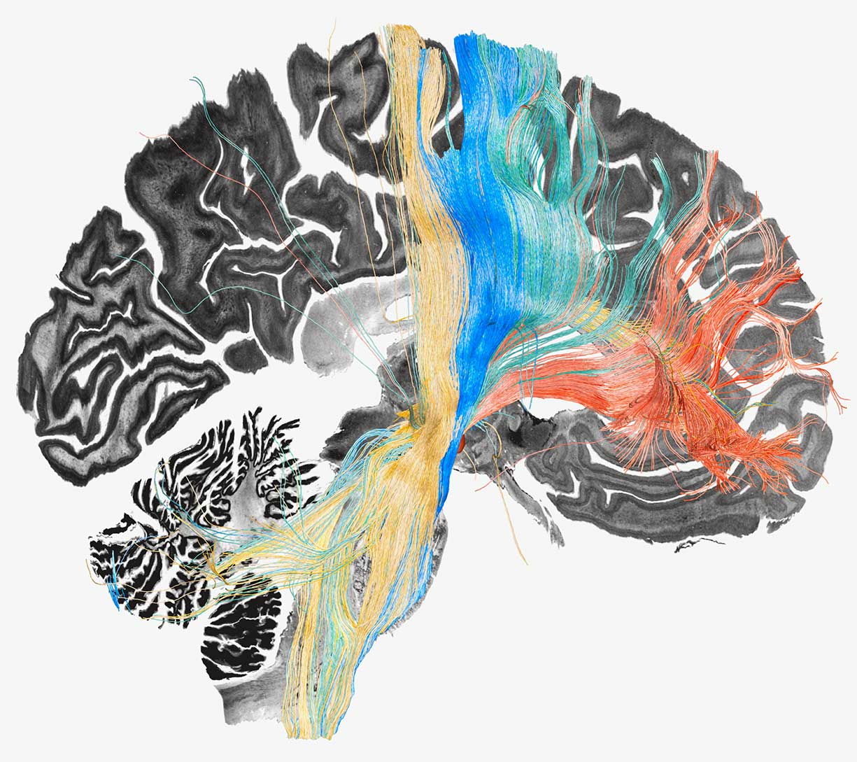 A side view of a brain with colored fiber bundles showing the connections between the frontal cortex and the basal ganglia.