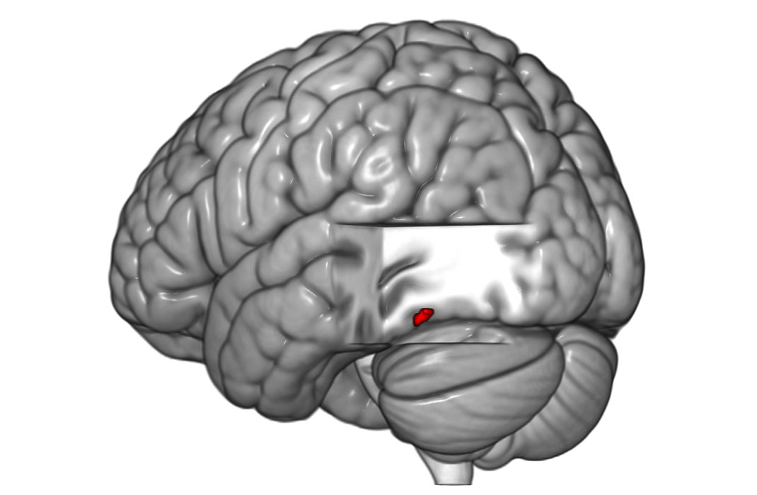 A gray image of a brain with a small red section, illustrating that brain injuries with aphantasia were connected to a specialized region of the brain active during visual imagination.