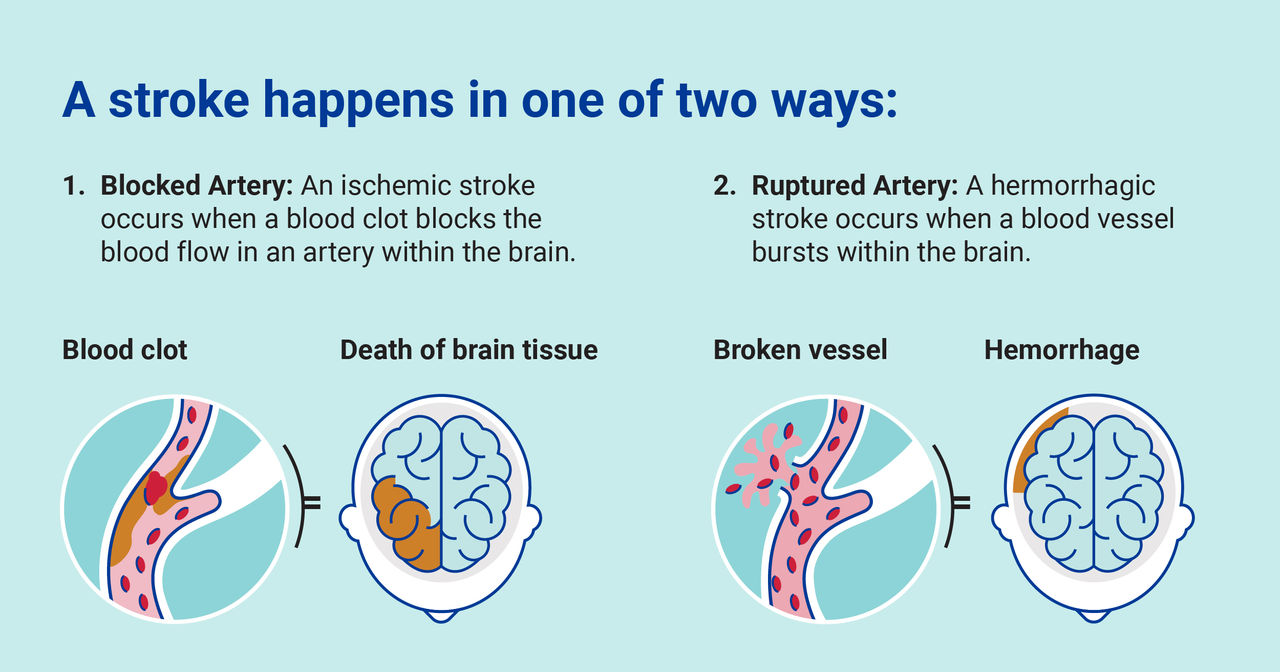 Hemorrhagic Stroke Treatment | Mass General Brigham