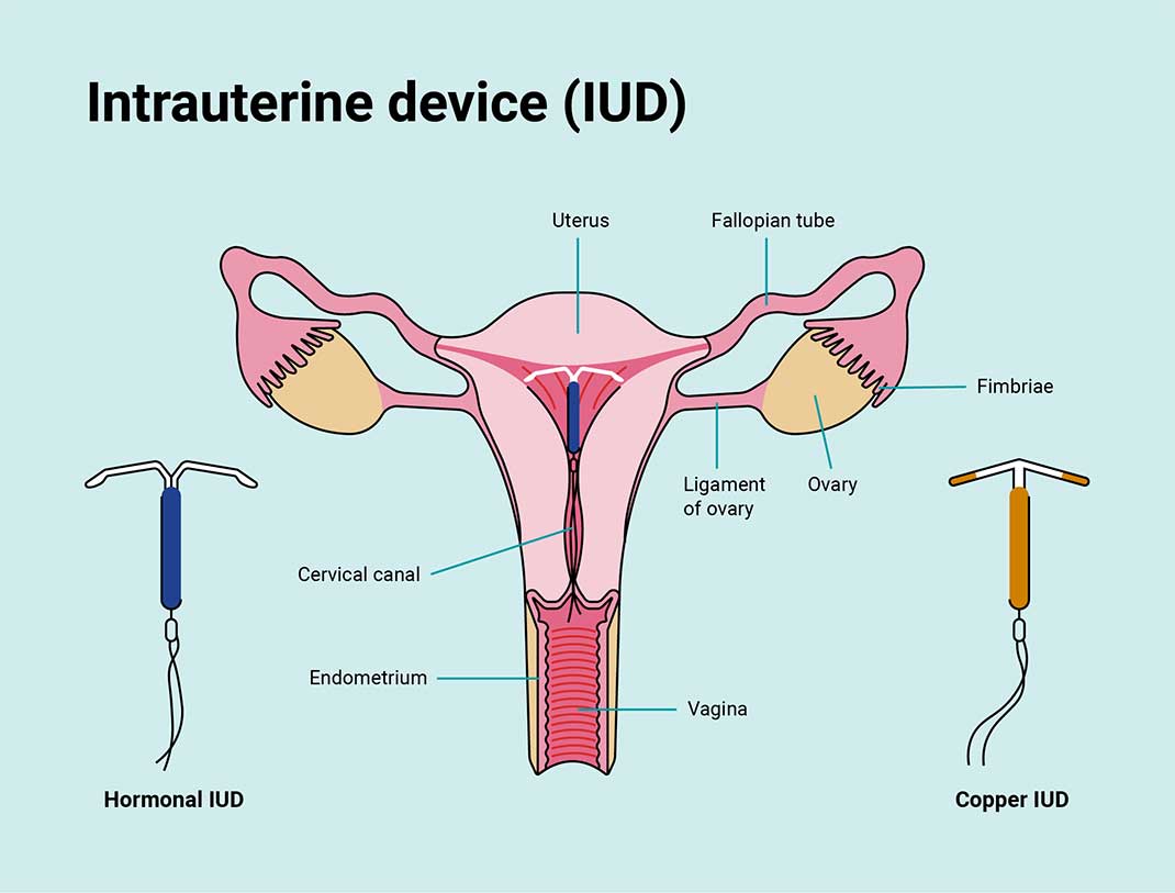 Diagram of the female reproductiive system with an IUD in place.
