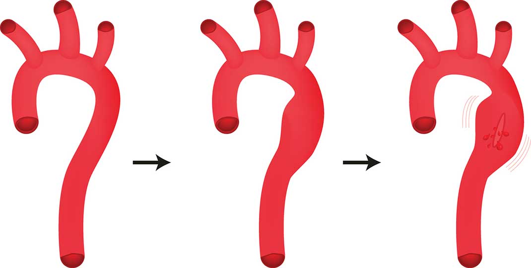 The three stages of an aortic aneurysm, from a normal aorta to a ruptured aneurysm.