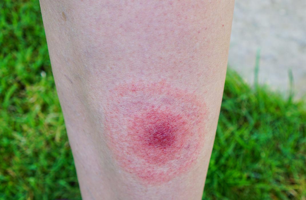 Lyme disease, Borreliosis or Borrelia, typical lyme rash, spot. A person, leg bitten by a deer tick. Selective focus.