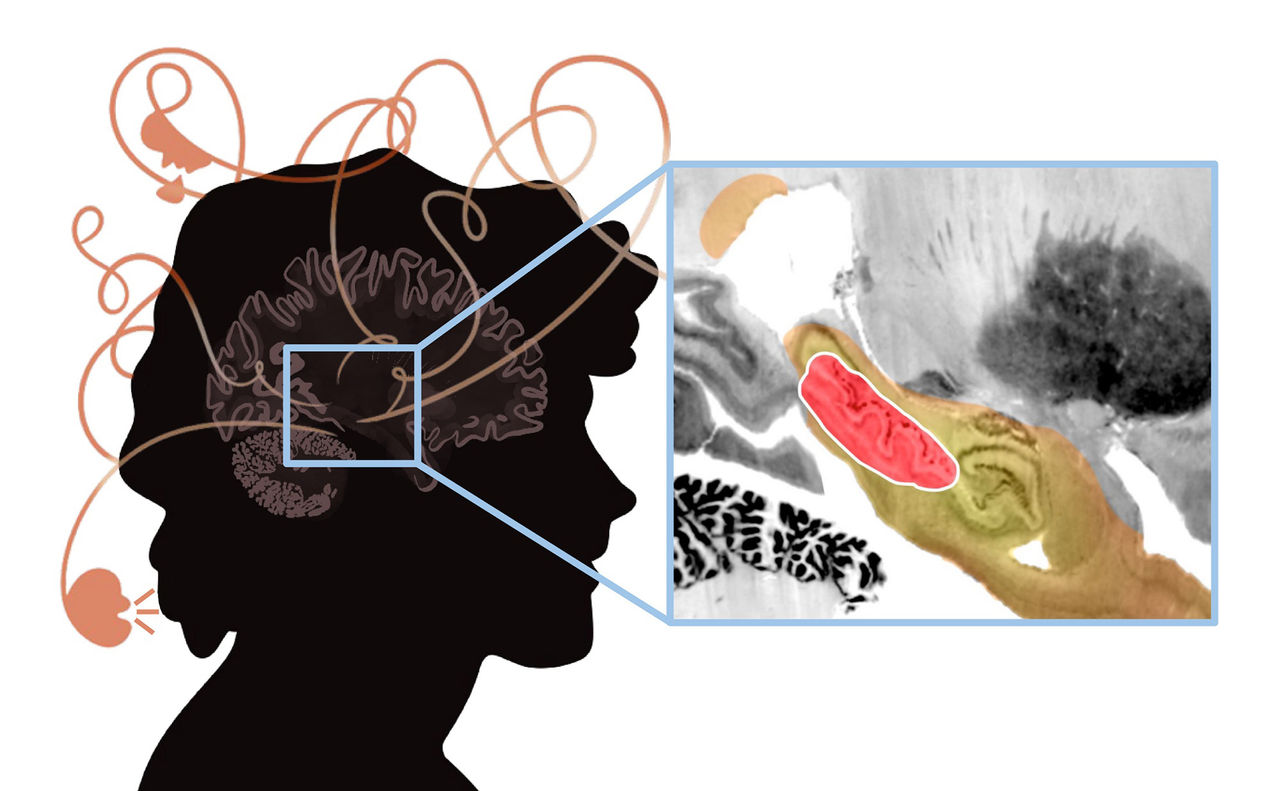 Illustration of a brain circuit mapping and lesion