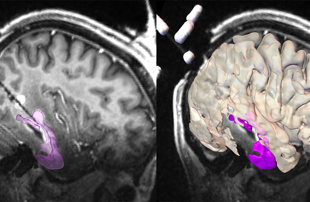 MRI and 3d rendering of a brain scan with tumor highlighted
