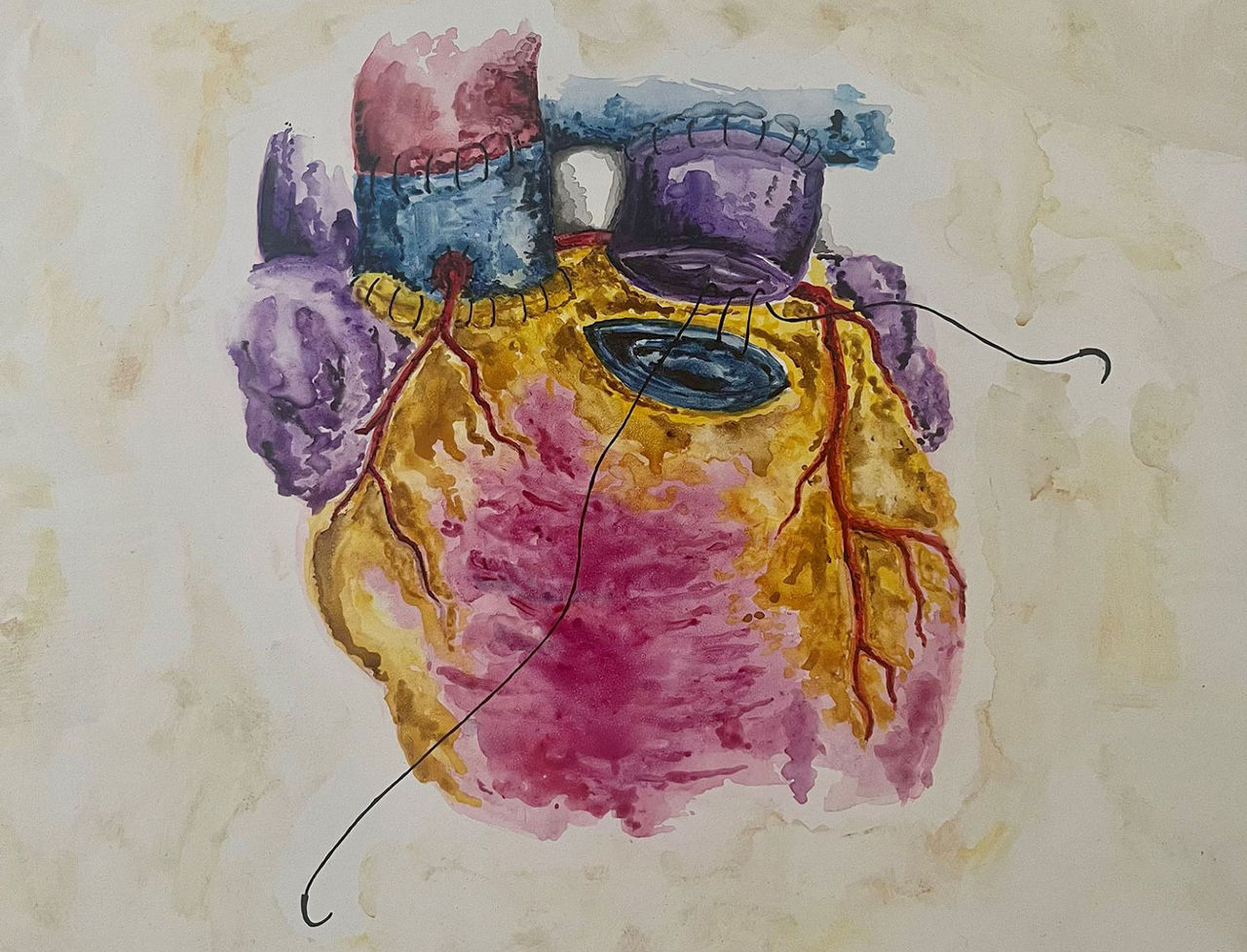 Watercolor of an anatomical heart showing the parts of the Ross procedure.