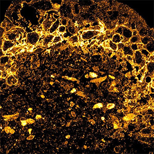 Cancer cells