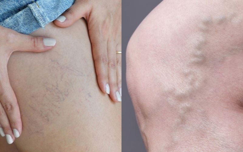 Comparison of spider veins and varicose veins.