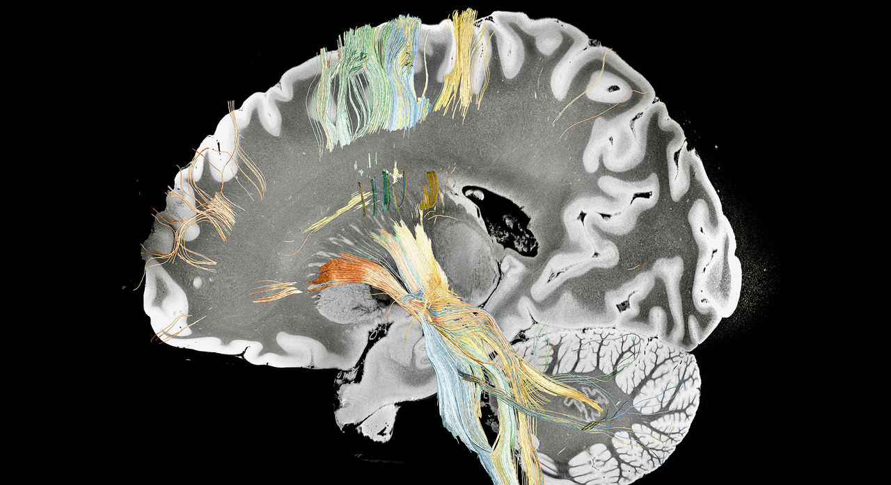 A cross-section of the brain displaying bundles of fibers relevant to improvement in Parkinson's disease.