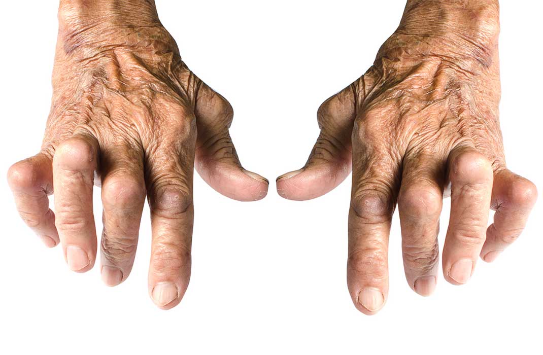 Hands gnarled from rheumatoid arthritis.