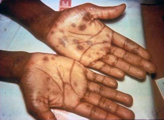 Syphilis sores covering both palms of a person's hands.