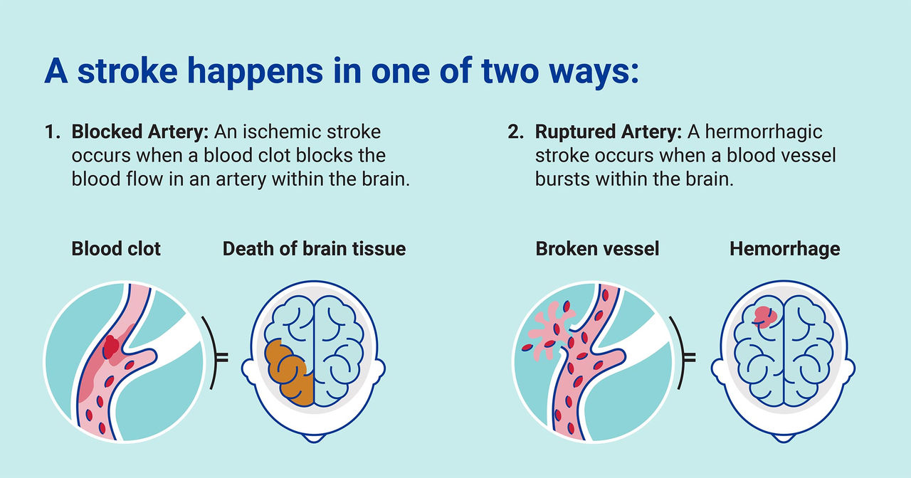 Diagram of the differences between ischemic and hemorrhagic strokes.