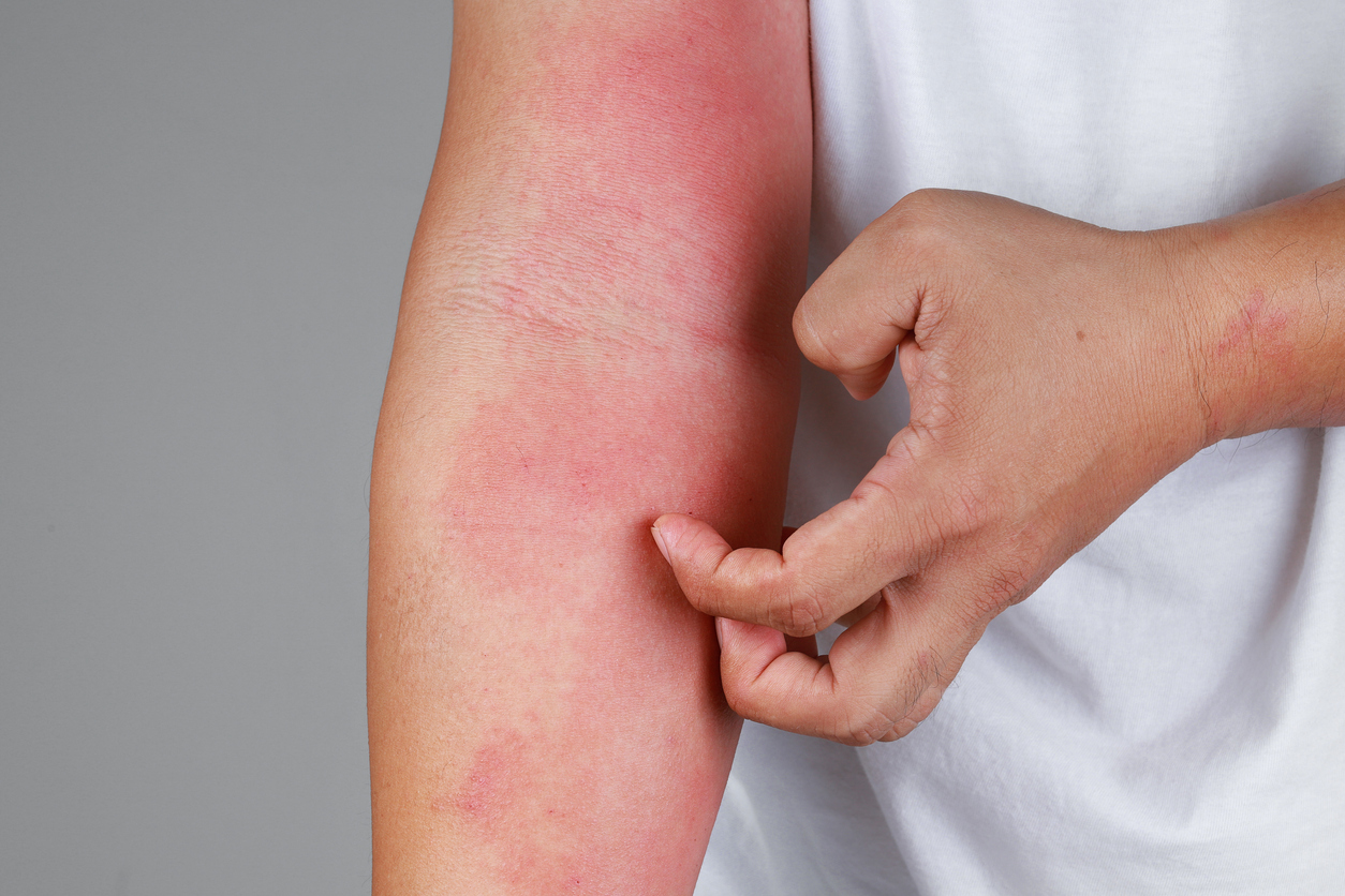 Eczema rash