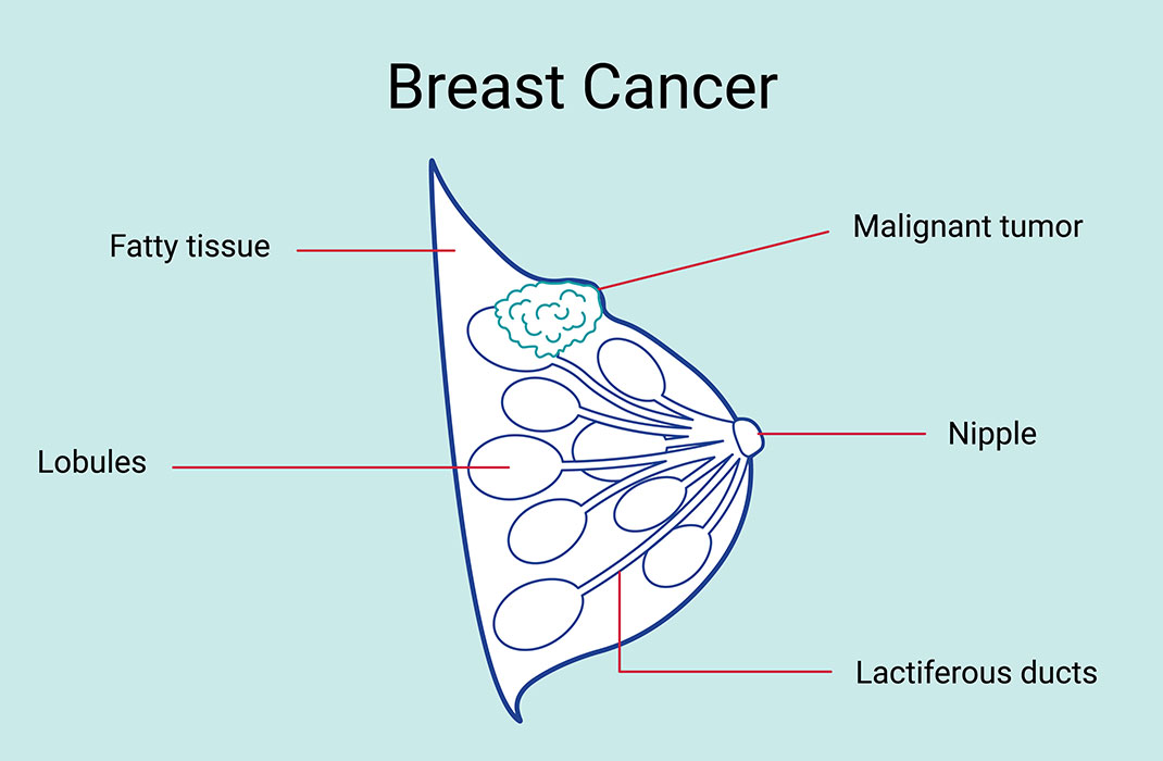 breast cancer diagram