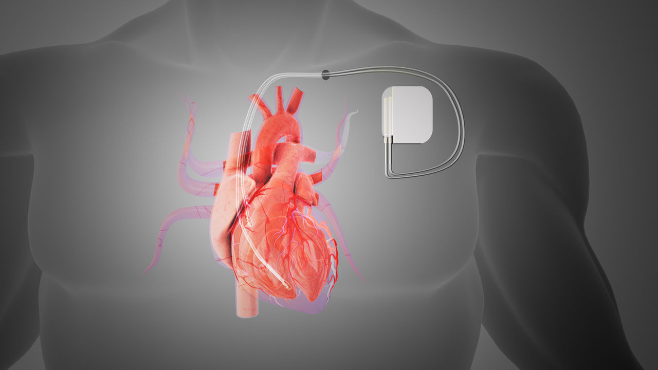 Diagram showing a pacemaker in the body