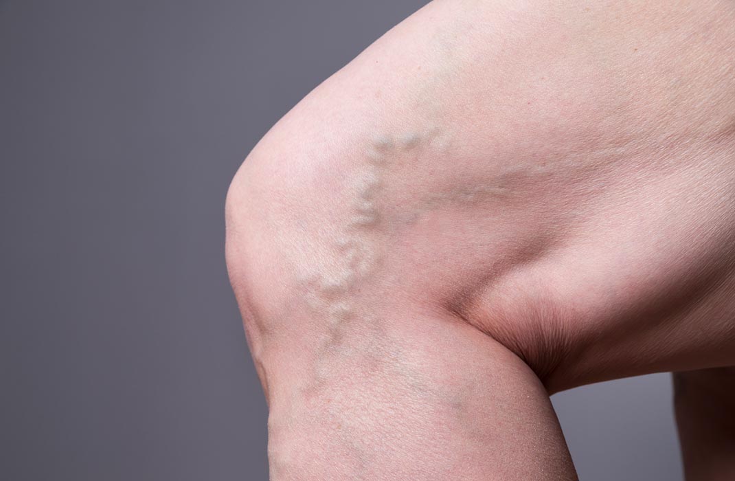 Close-up of varicose veins on the knee