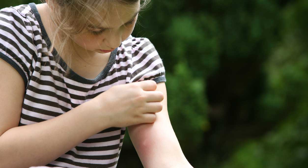 A young woman scratches a bug bite on her arm.