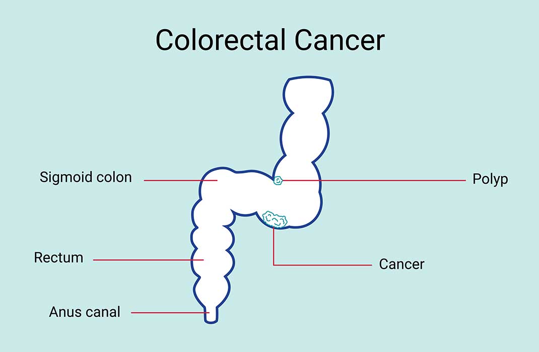 Diagram of the colon and rectum showing a cancer and polyp.
