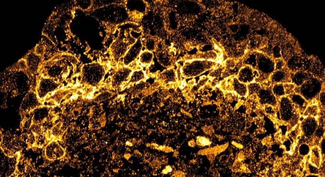 Like avoiding "the floor is lava," cancer cells adapt and manipulate their microenvironment to survive, creating safe zones and pathways for growth within a reactive, often antagonistic space. Submitted by: Radhika Koranne, PhD