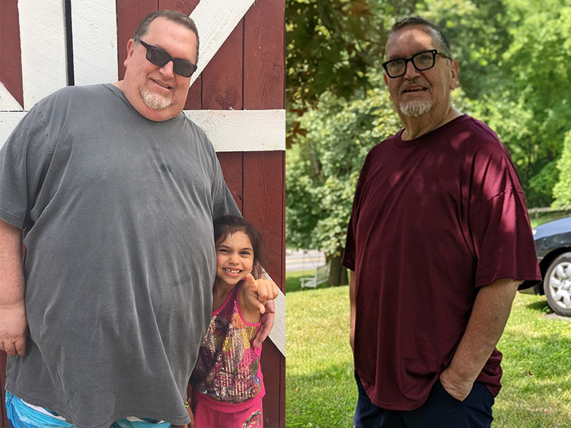 Before and after a sleeve gastrectomy bariatric surgery side-by-side collage: patient in sunglasses and a grey t-shirt at a higher weight on the left, while the patient is in glasses, maroon t-shirt, and blue jeans at a lower weight on the right