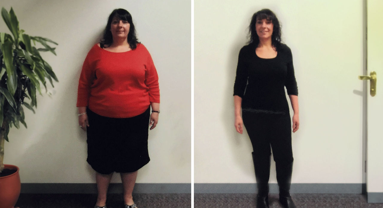 Newton-Wellesley Hospital Center for Weight Loss Surgery patient before and after bariatric surgery.