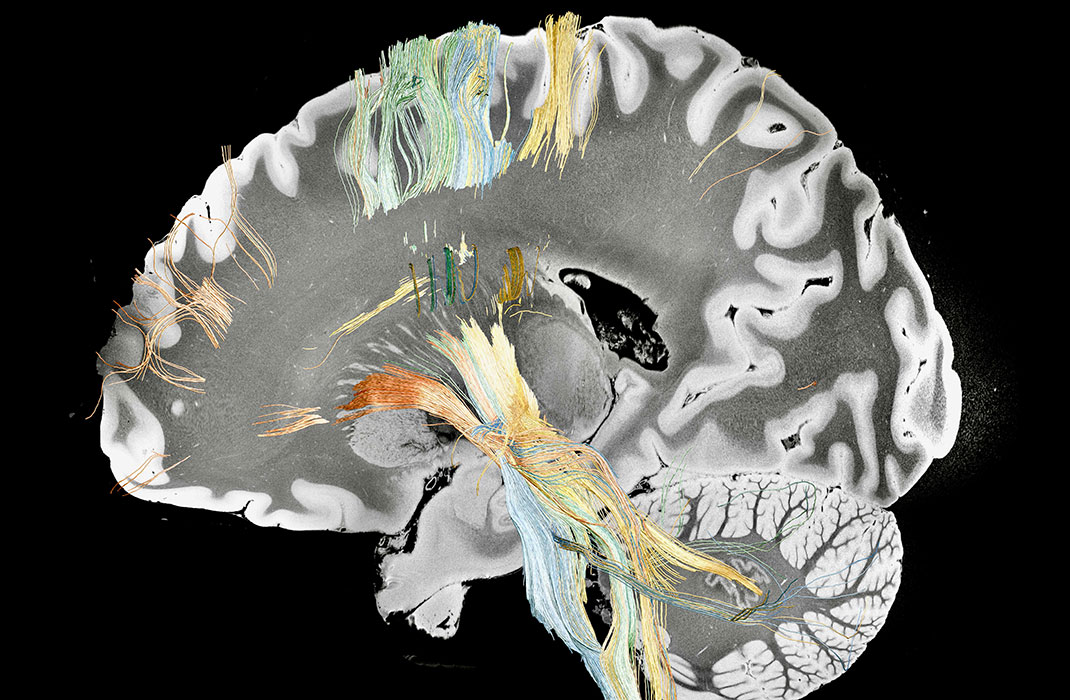 A cross-section of the brain displaying bundles of fibers relevant to improvement in Parkinson's disease.