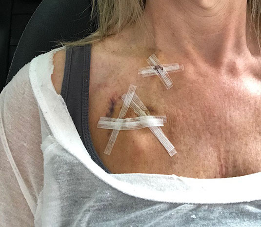When Julianne was getting her port, the nurse asked her about her son, Ayden, to keep Julianne’s mind occupied. When Julianne removed the bandages later on, she realized that the nurse had made an “A” out of the tape in honor of her son.   