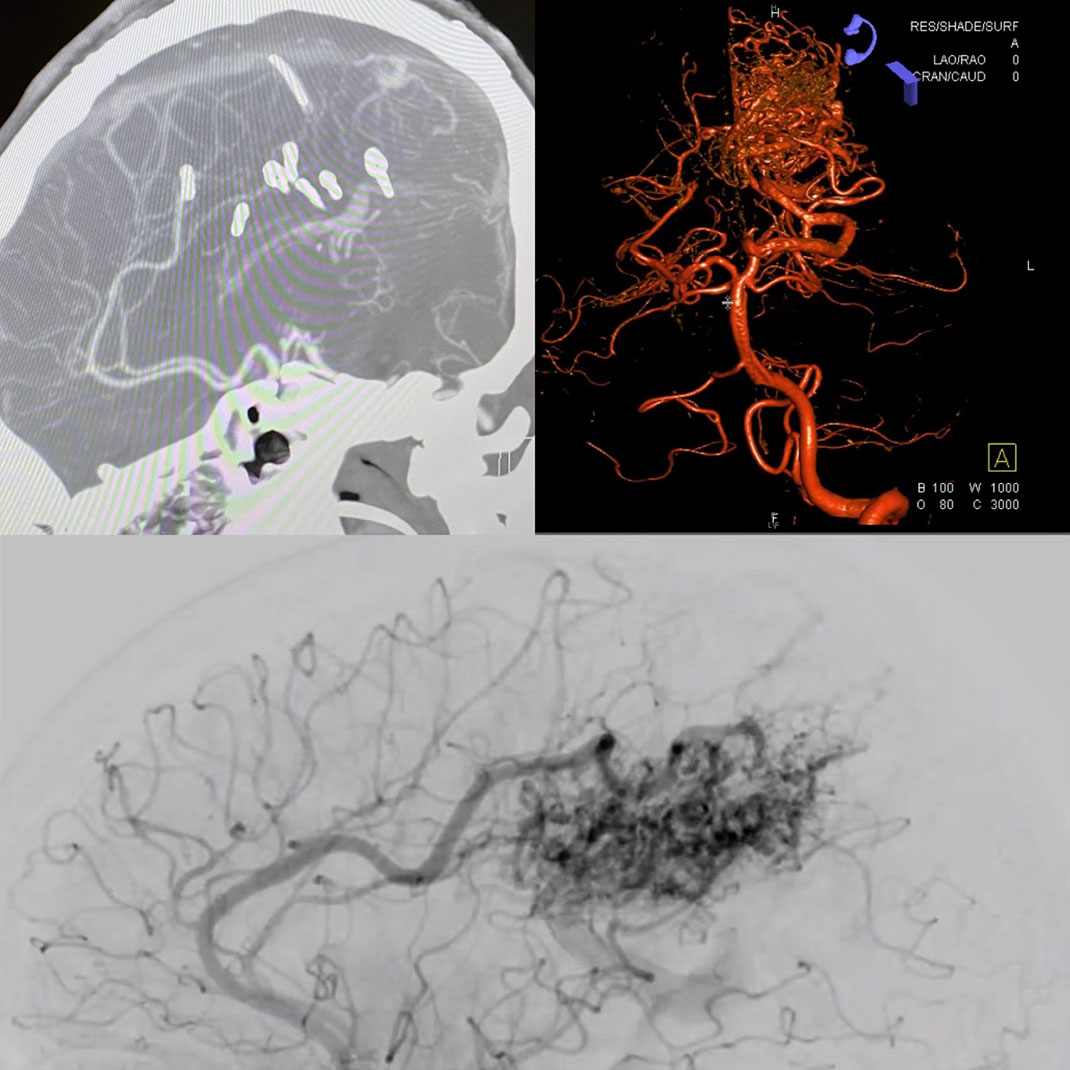 Brain scans showing AVM formations.
