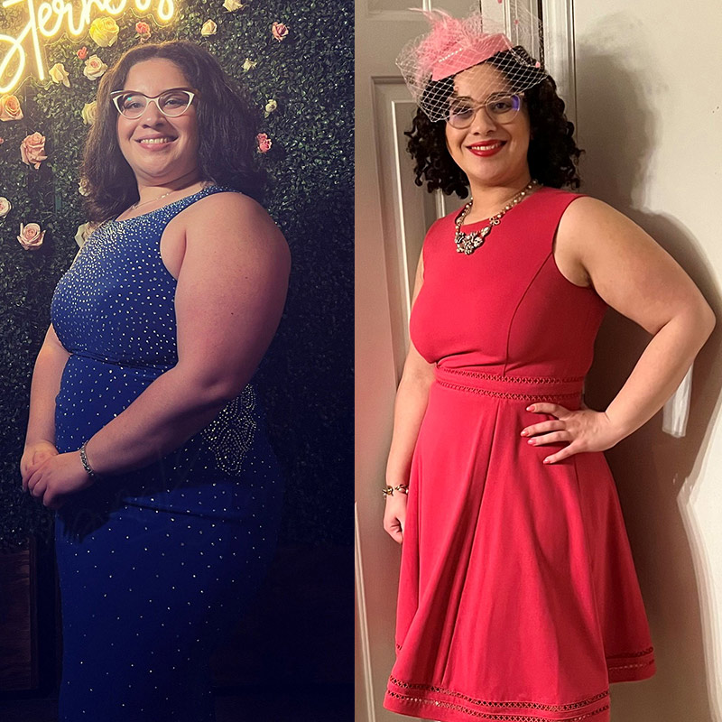 Before and after bariatric surgery side-by-side collage: patient in blue dress and glasses in a before picture on the left, while for the after picture on the right, the patient is in a peach-colored dress with glasses
