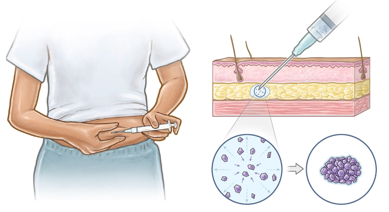 Patient-friendly approach to self-administered contraceptive shots